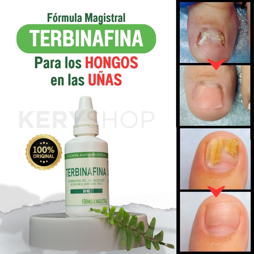 ADIOS A LOS HONGOS: TERBINAFINA EN GOTAS PARA TUS UÑAS